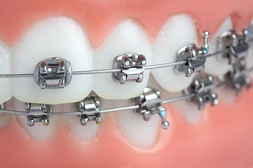 Orthodontist Stockton CA, Conventional Braces