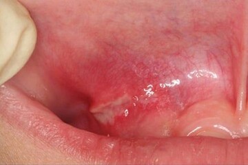 Canker Sores