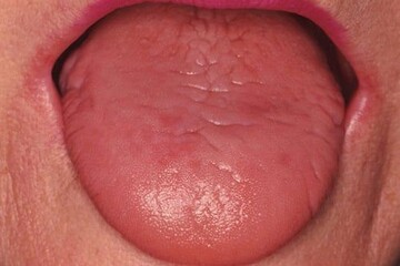 Dry Mouth